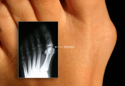 Hallux Valgus
