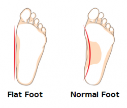 Causes and Risk Factors of Flat Feet or Fallen Arches