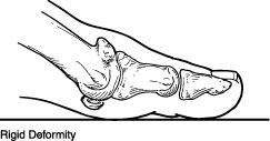 Hallux Rigidus