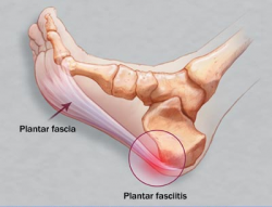 Plantar Faciitis