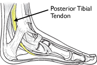 Posterior Tibial Tendon