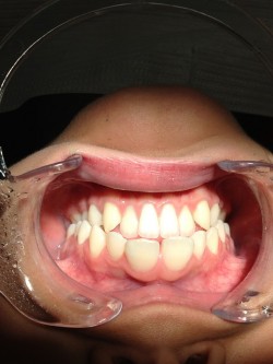 Your Teeth and Thyroid